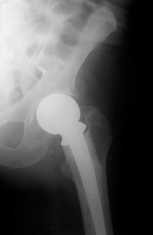 Artificial hip Xray